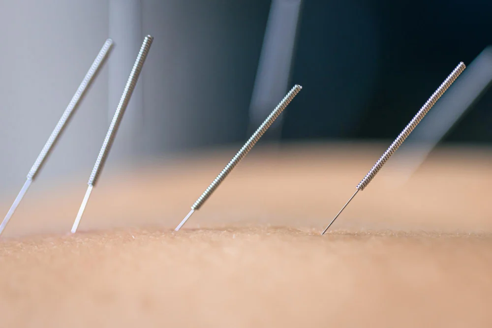 Acupuntura médica